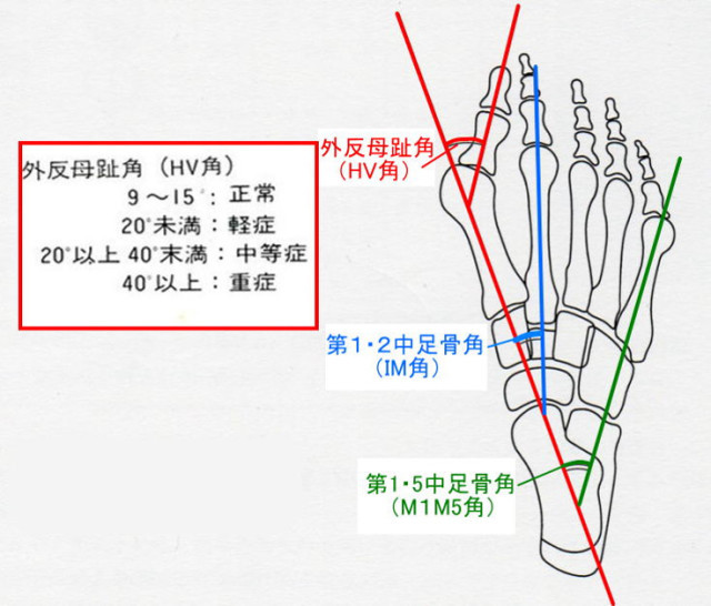 外反母趾角